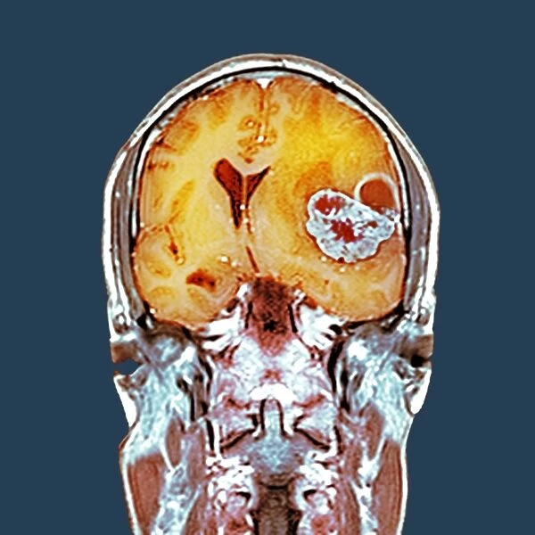 Brain cancer, MRI scan C016  /  4436