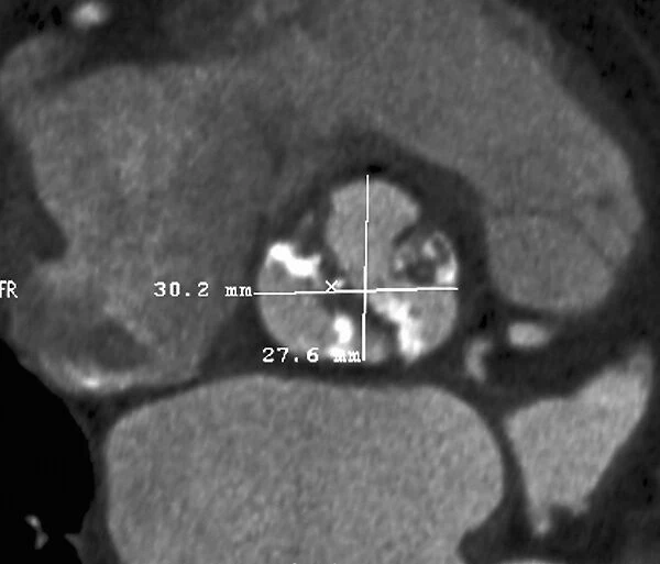 Calcified heart valve, CT scan