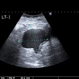 Endometrial cyst, ultrasound scan C017 / 8006