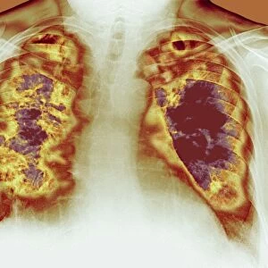 Loss of lung tissue, X-ray