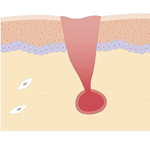 Cross section biomedical illustration of damaged skin and blood vessel