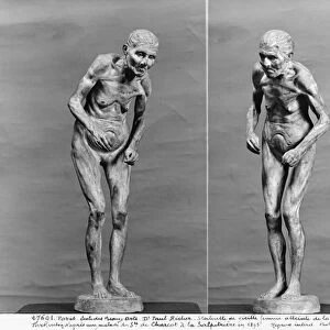 Statuette of an old woman with Parkinsons disease, after 1895 (plaster) (b / w photo)